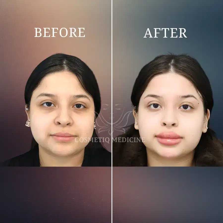 Lip filler before and after showing improved upper to lower lip balance