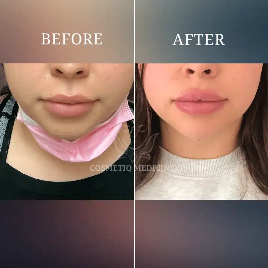 Lip filler before and after close up showing fuller lips and a crisper lip border