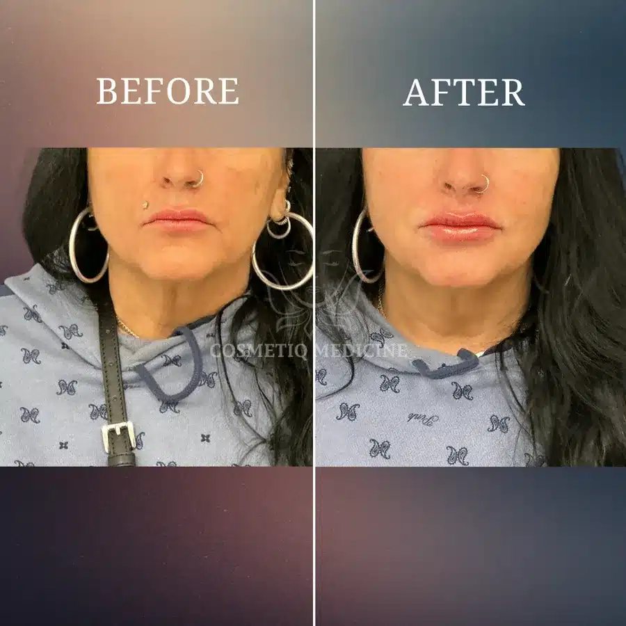 Lip filler before and after showing added lip volume and improved lip line definition