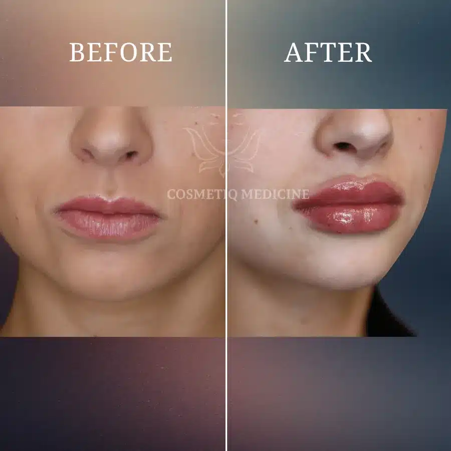 Lip filler before and after showing added volume across both lips with natural proportion retained