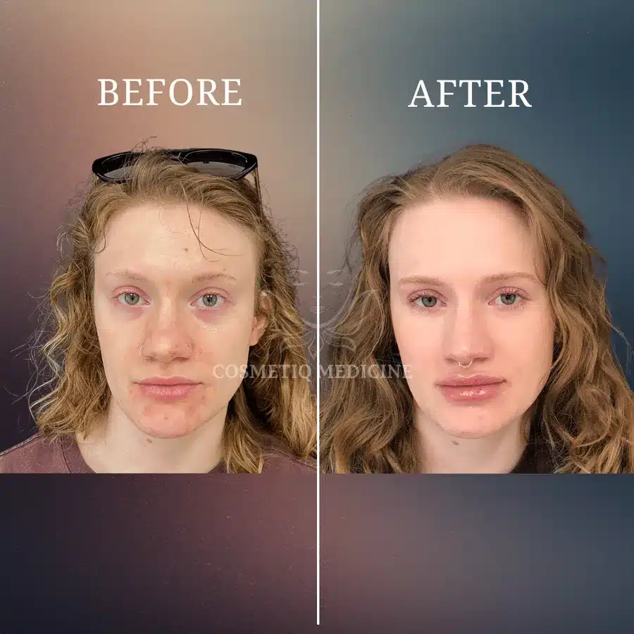 Lip filler before and after showing a modest, natural increase in lip fullness