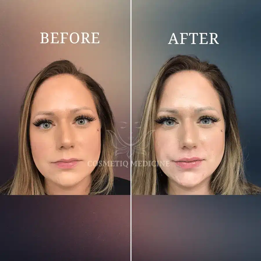 Lip filler before and after showing added fullness while keeping natural lip shape