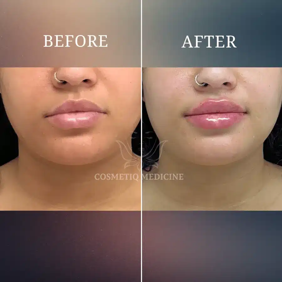Lip filler before and after showing softer lip definition becoming fuller and more balanced