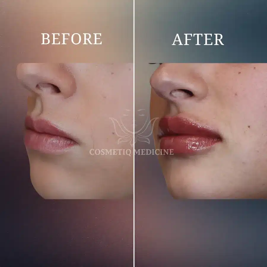 Lip filler before and after in profile showing increased upper and lower lip volume with the vermillion border still defined
