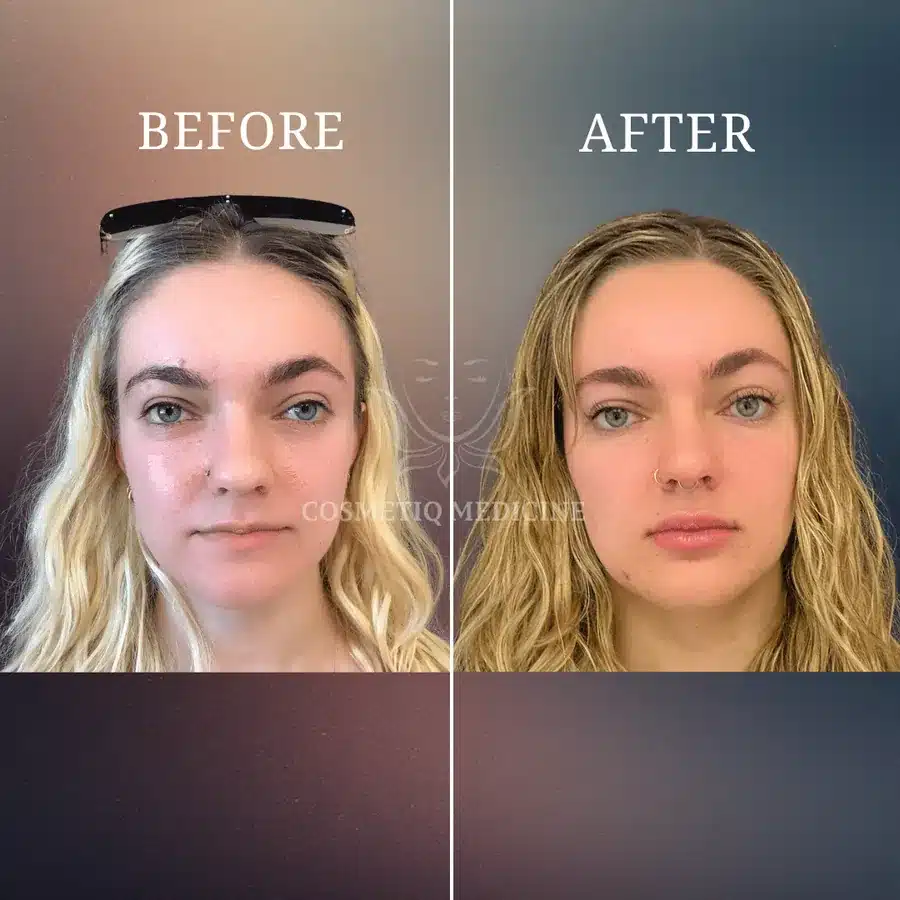 Lip filler before and after showing restored lip volume with a defined border