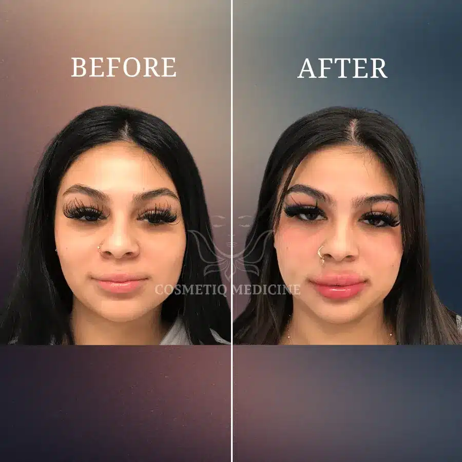 Lip filler before and after on a younger patient showing subtle added fullness