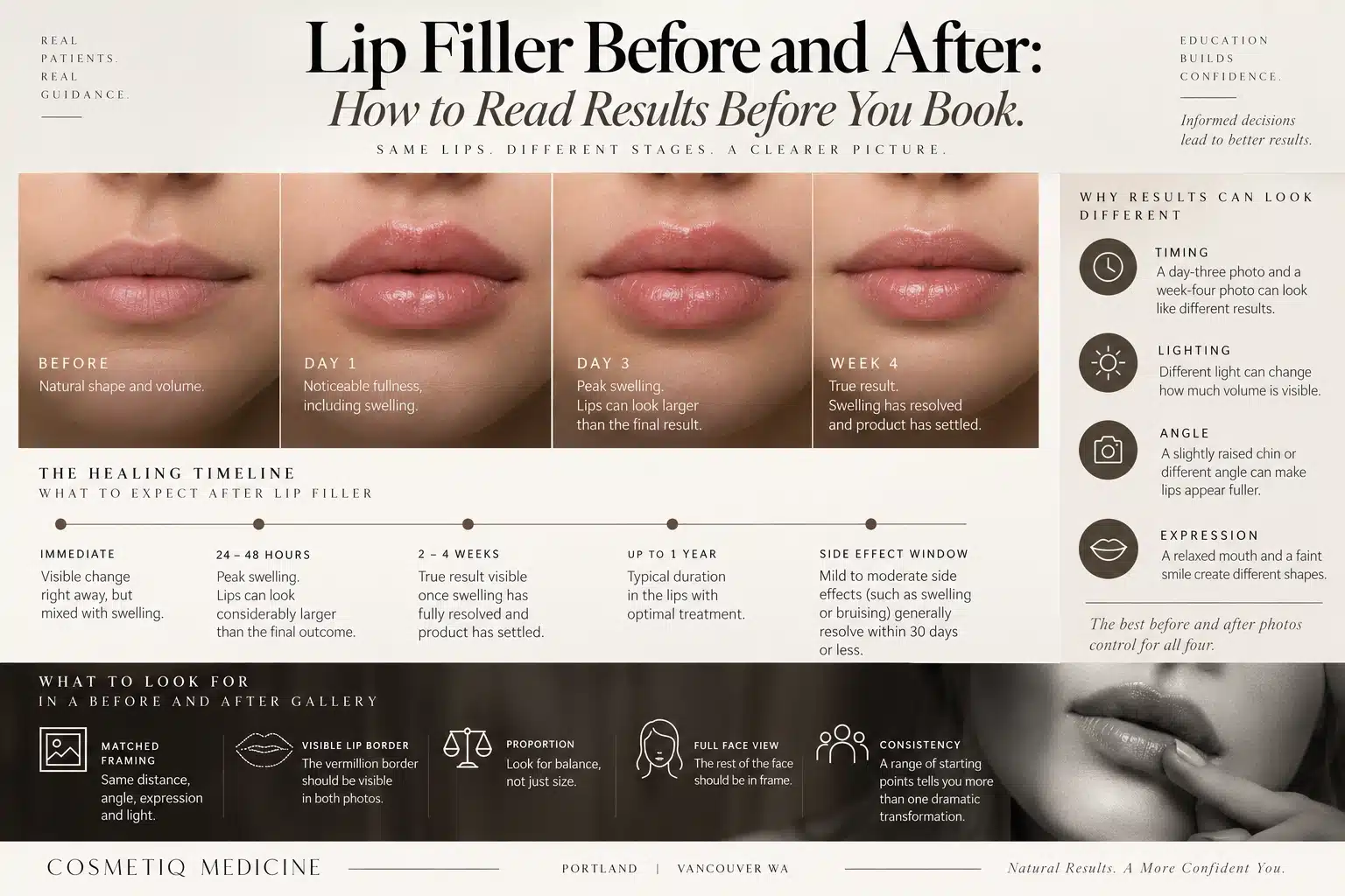 Lip filler healing timeline showing the same lips before treatment, at day one, at day three peak swelling, and the settled week four result