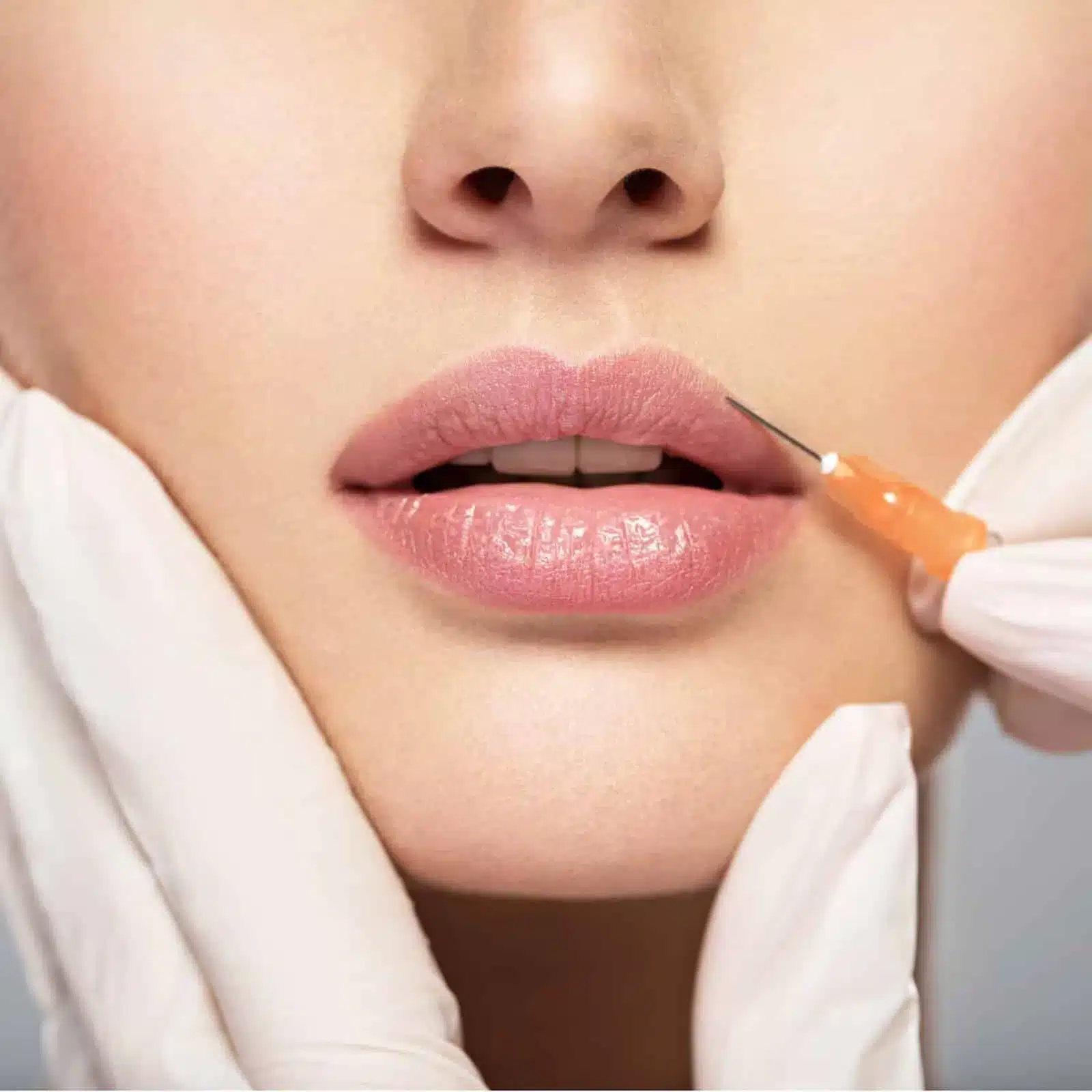 Lip filler placed with a fine needle at the Portland clinic