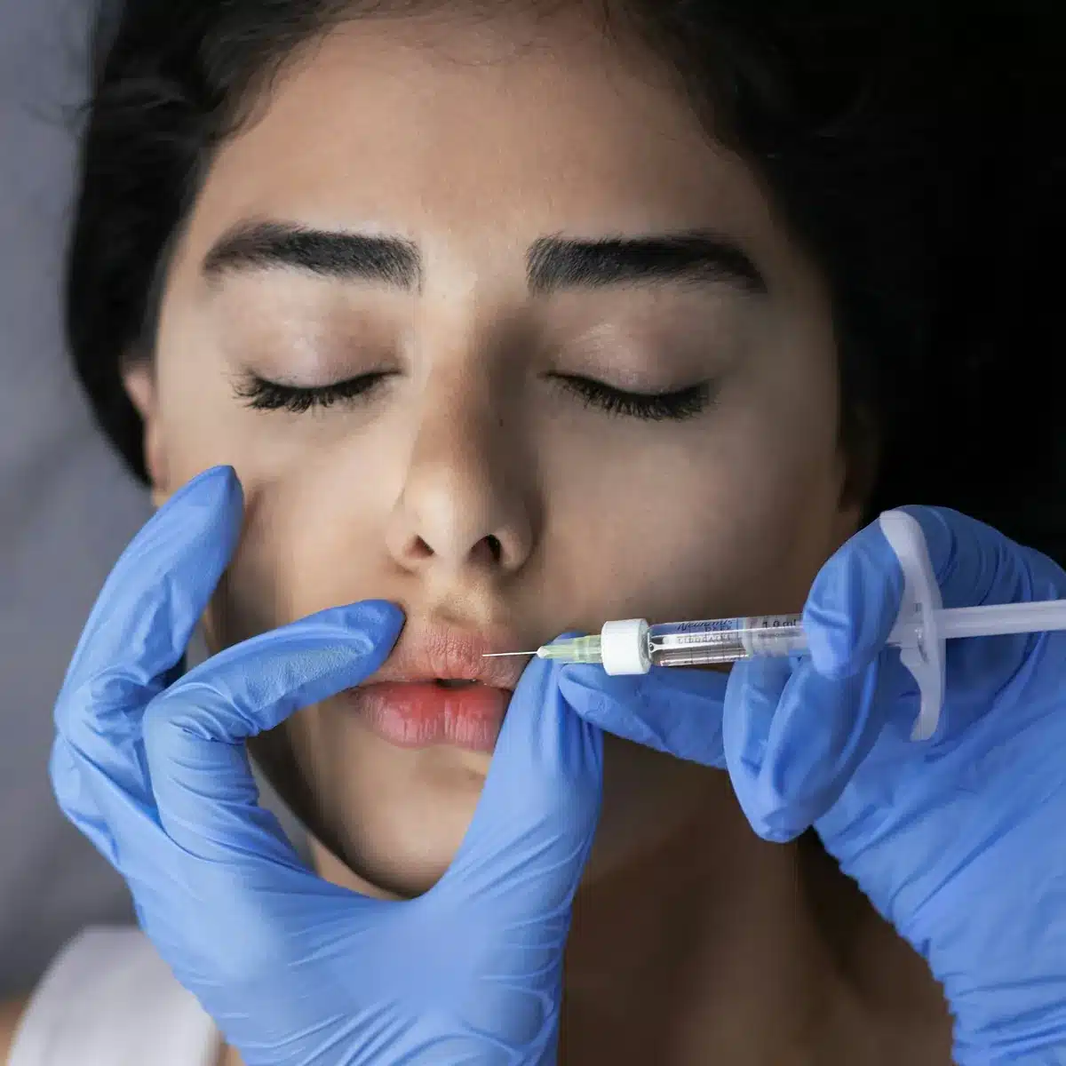 Lip filler injection along the upper lip, the treatment offered at Cosmetiq Medicine in Vancouver, WA