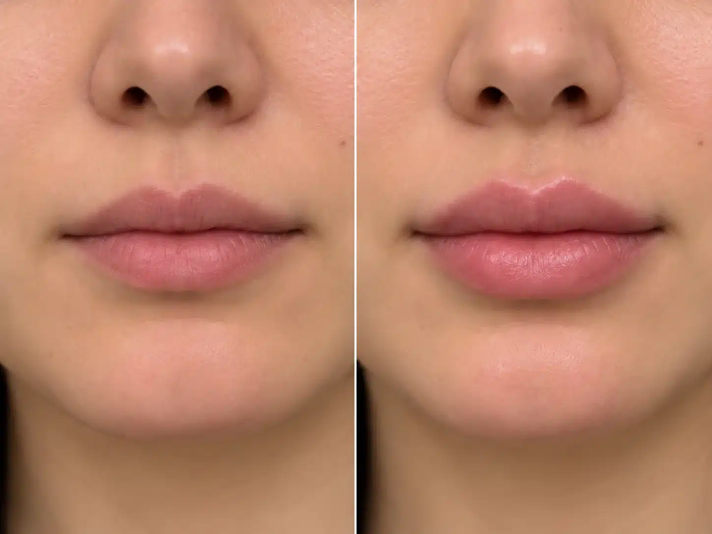 Illustration of natural lip filler volume before and after for the $520 October lip filler special in Portland and Vancouver, WA