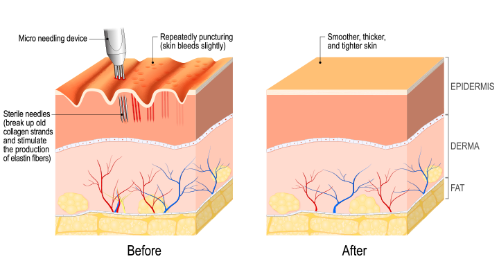 Infographic showing the process of microneedling and how the needles penetrate the collagen of the epidermis.