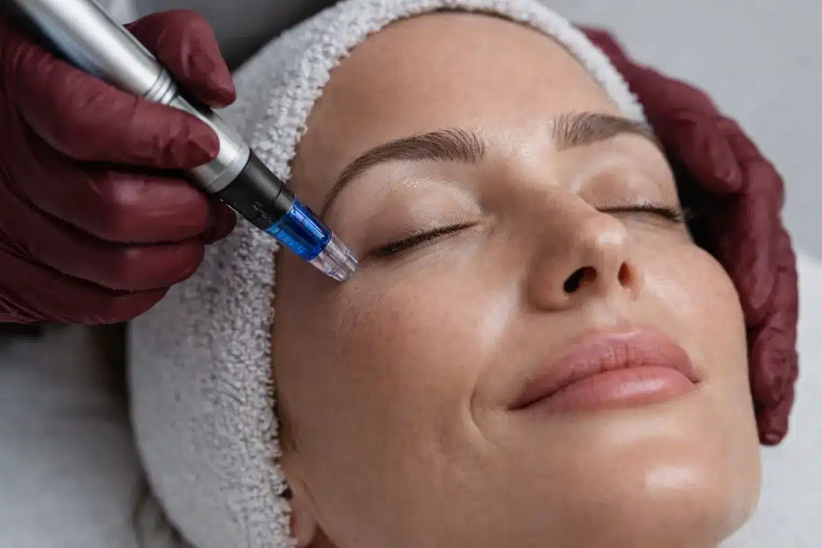 Microneedling pen gliding across a cheek during collagen induction therapy in Portland