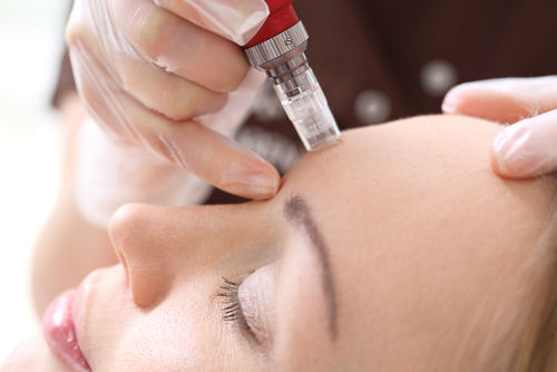 Photo of a Microneedling procedure being performed on a patient.