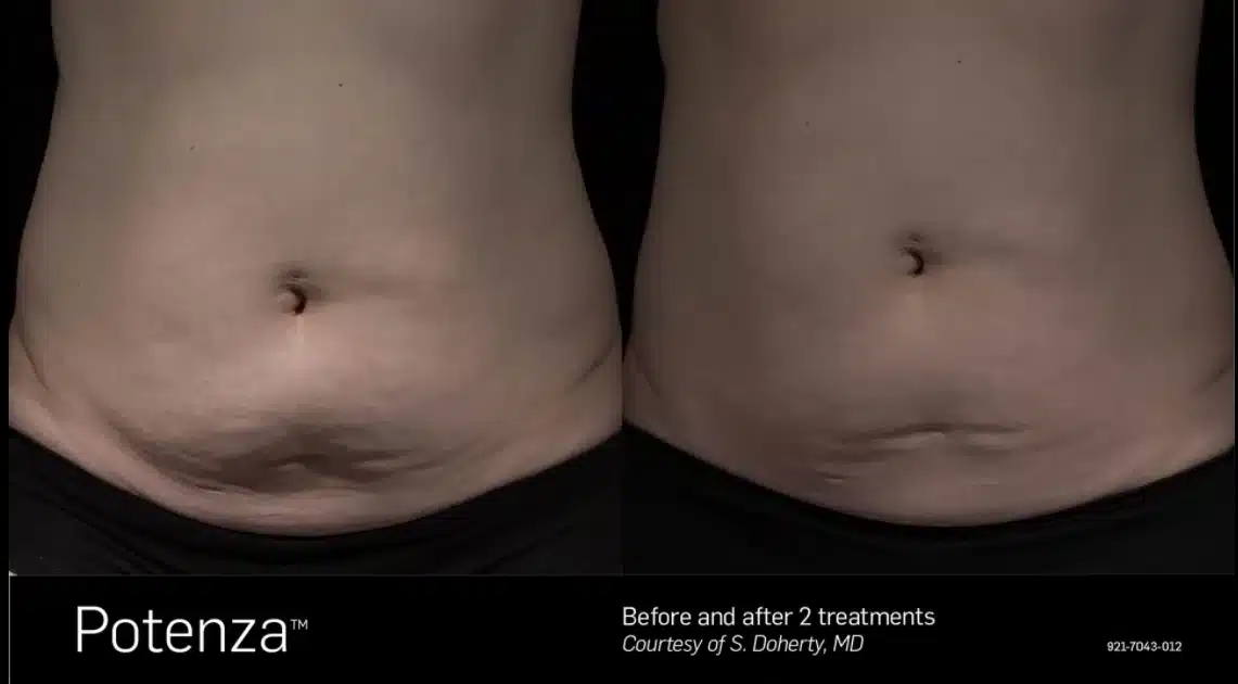 Potenza RF microneedling before and after: abdomen skin after two treatments
