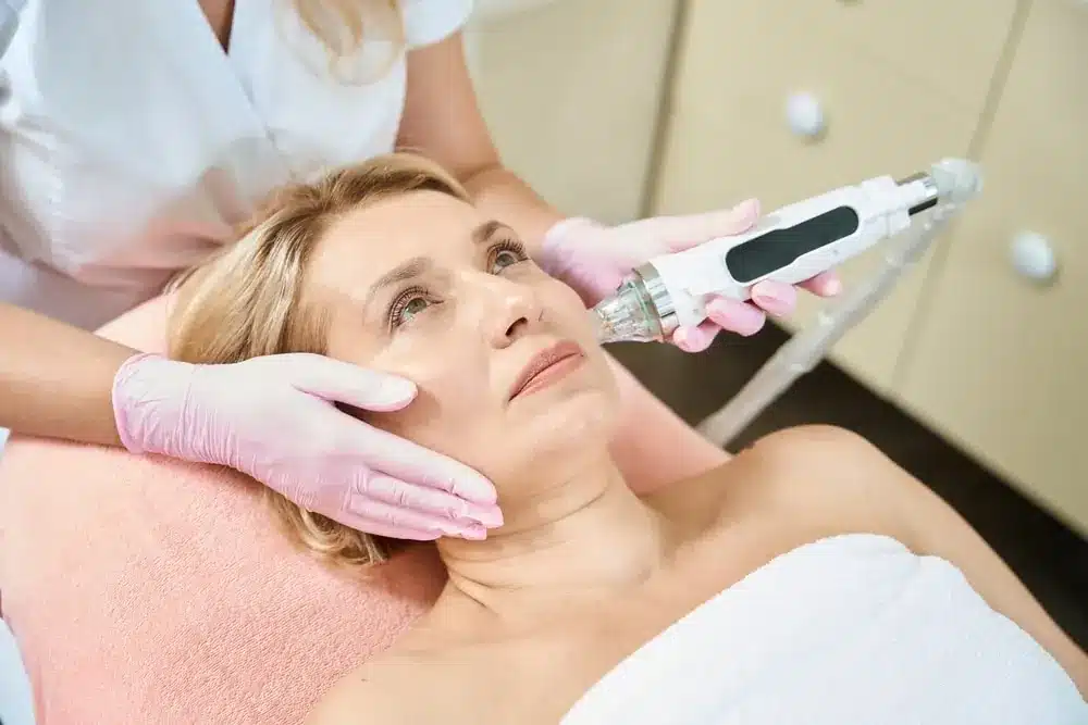 RF microneedling treatment along the cheek and jaw at our Portland clinic