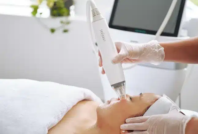 Potenza RF microneedling handpiece used at the Vancouver, WA clinic