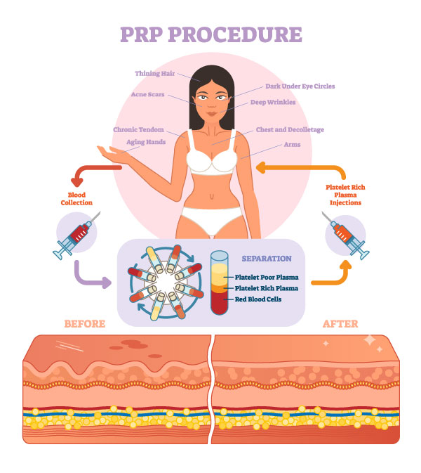 An infographic showing the process by which PRP is made and used. Including the collection of blood from the patient, the separation of said blood into PRP (Platelet Rich Plasma), and the reinjection of said plasma to the desired areas.
