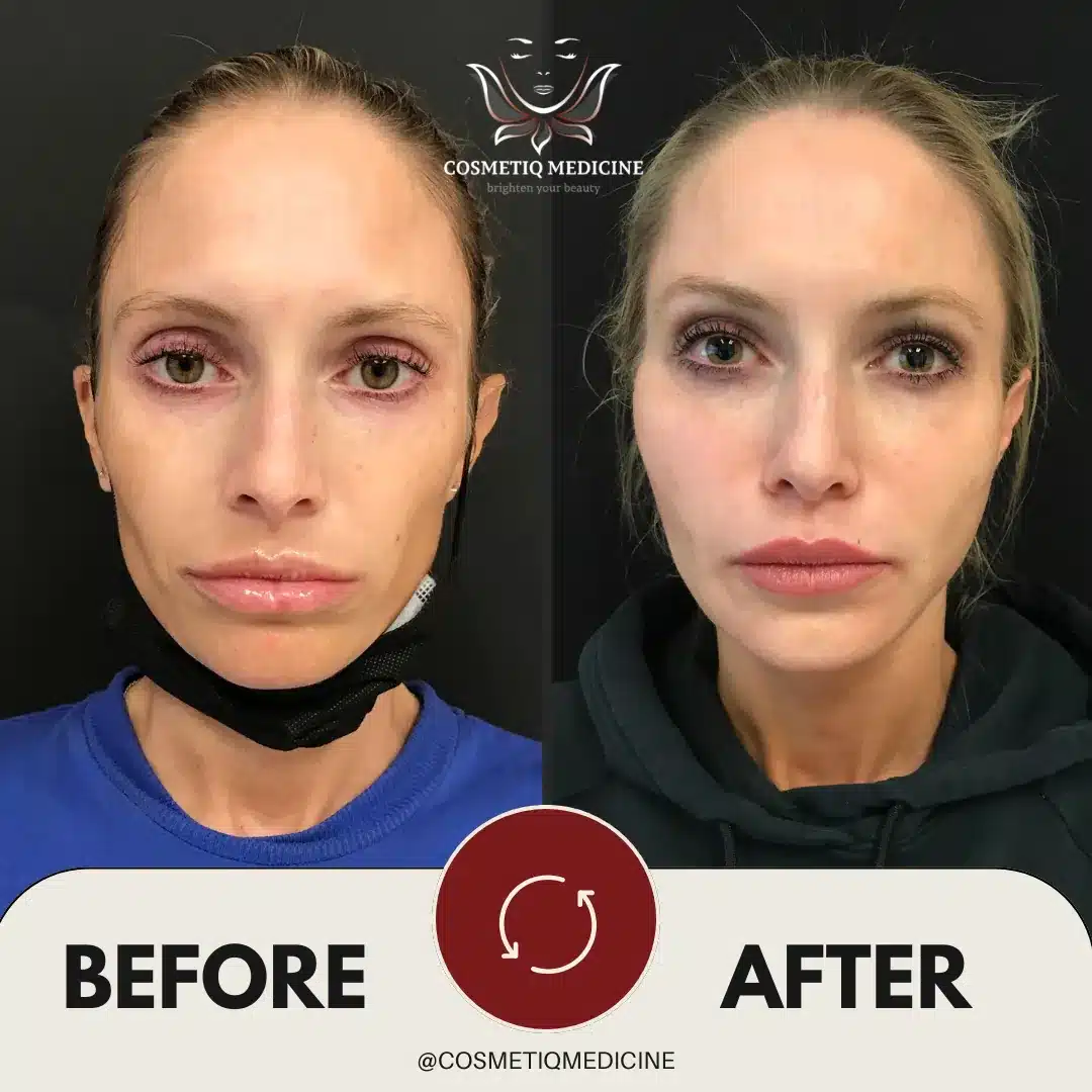 Sculptra before and after photo of a Cosmetiq Medicine patient, front view