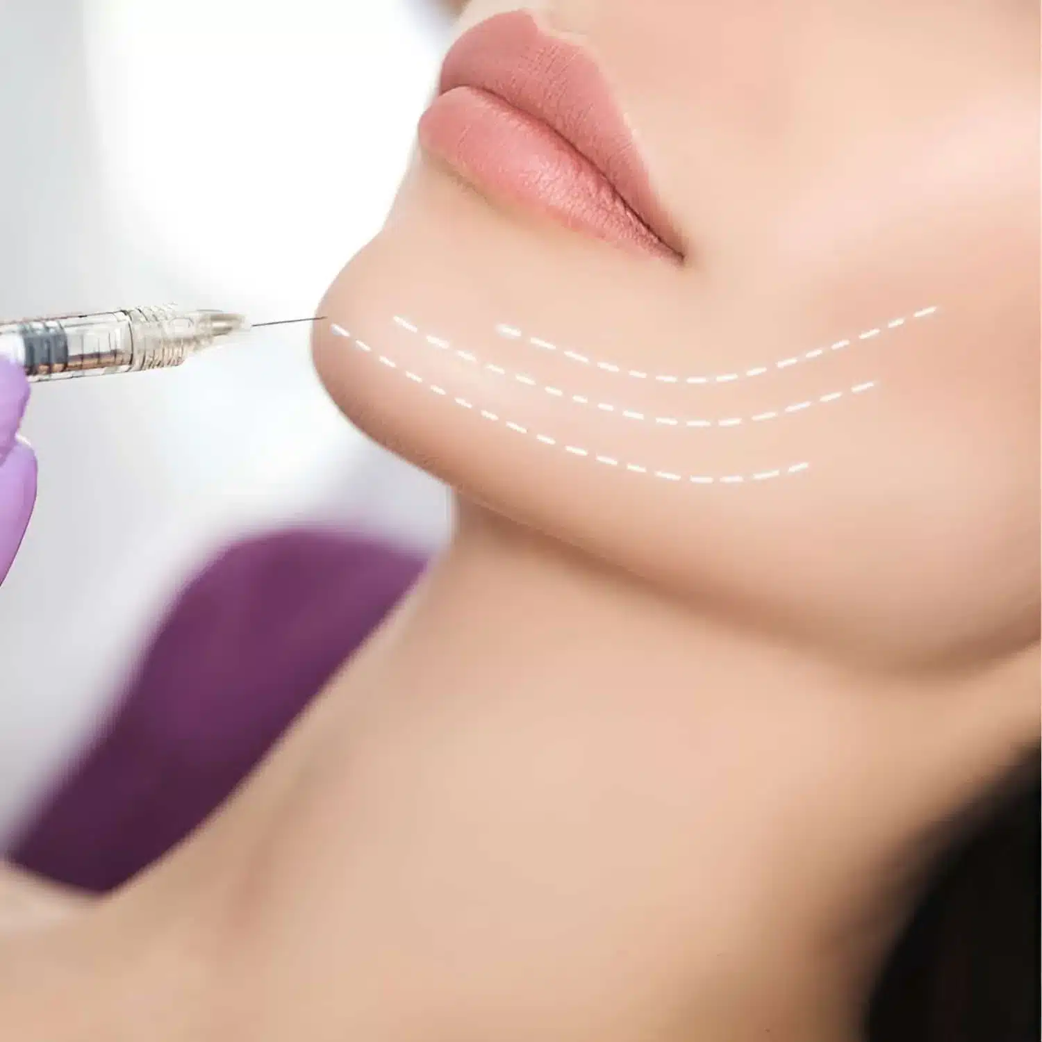 Jawline injection with contour guide lines at our Portland clinic