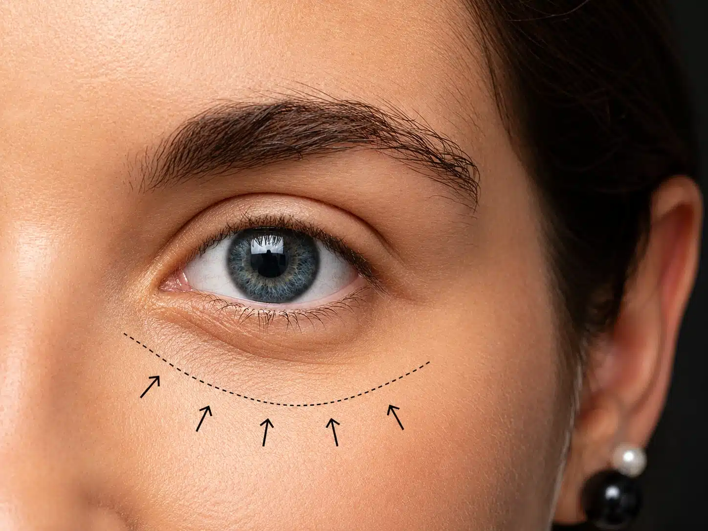 Under-eye and tear trough filler guide from Cosmetiq Medicine