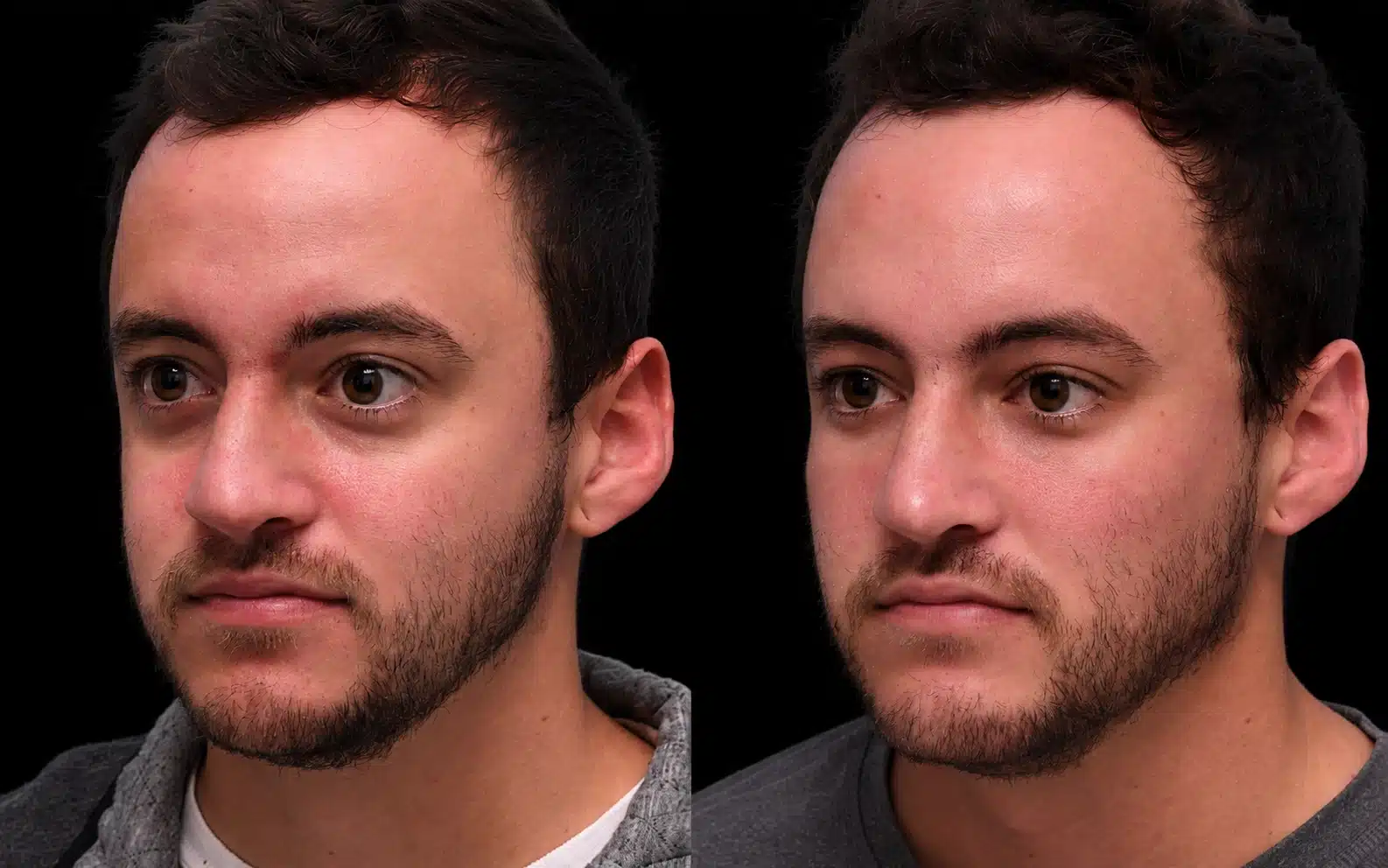 Under-eye filler treatment for tear trough hollows at Cosmetiq Medicine in Portland and Vancouver