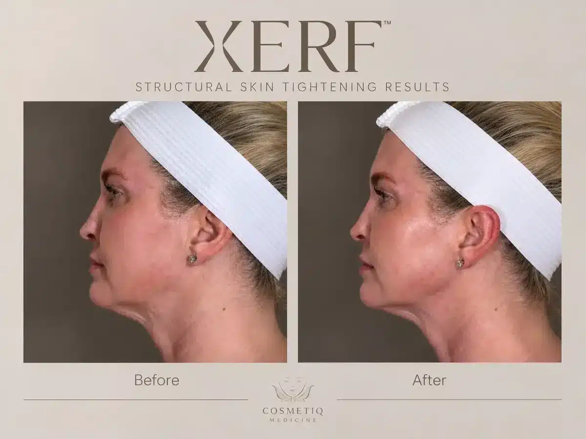XERF skin tightening before and after, side profile of a woman's jawline and neck