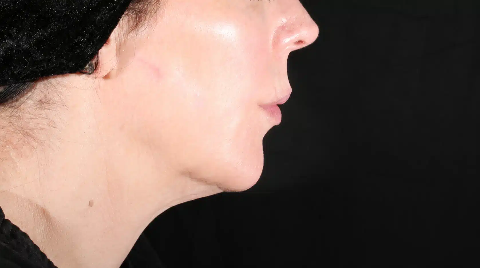XERF before and after jowls result showing reduced lower-face overhang after non-surgical radiofrequency skin tightening in Vancouver WA near Portland Oregon