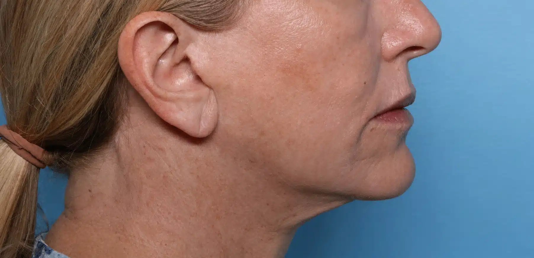 XERF before and after jawline results showing sharper mandibular definition after RF skin tightening near Portland Oregon and Vancouver Washington