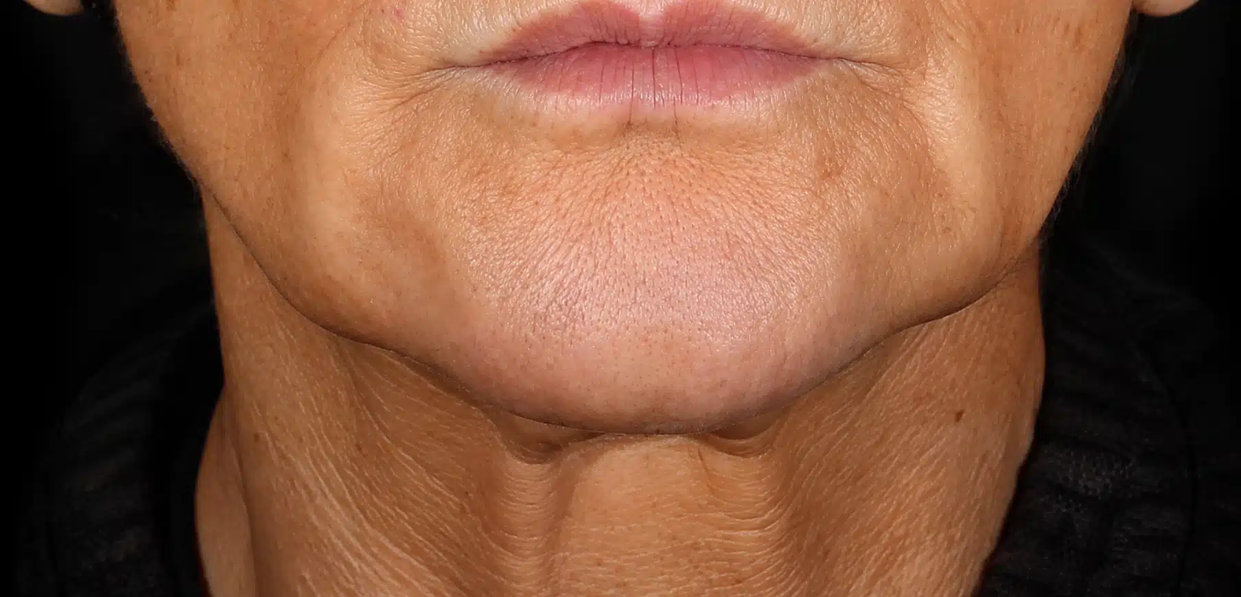 XERF before and after neck results showing improved submental angle and reduced skin laxity after non-invasive RF skin tightening in Vancouver WA