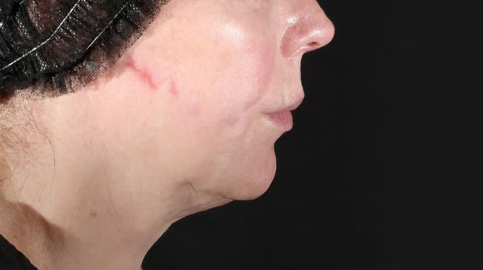 Before XERF treatment showing jowl formation and loss of jawline definition in the lower face