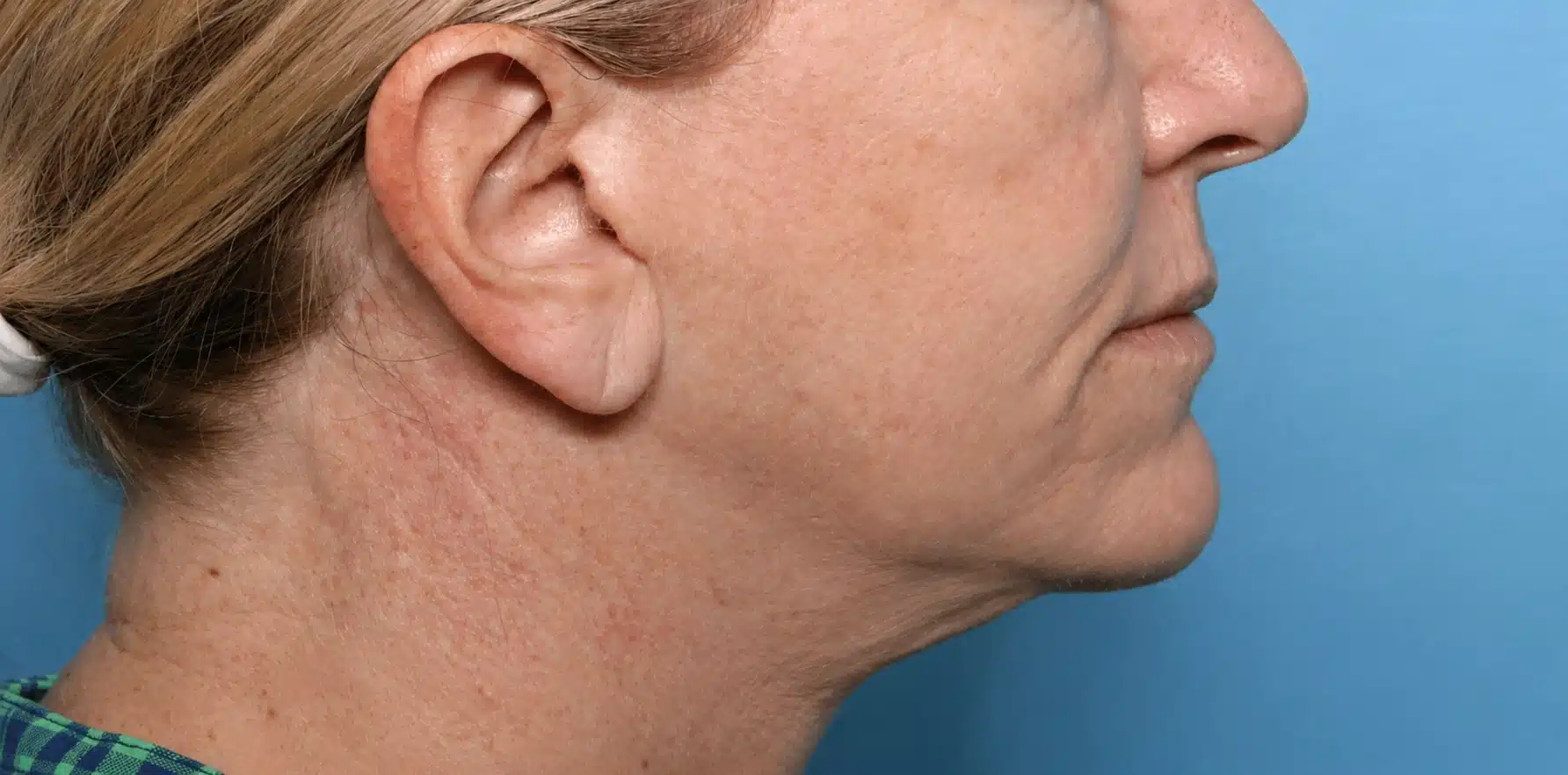 Before XERF radiofrequency treatment showing softened jawline definition and lower face laxity