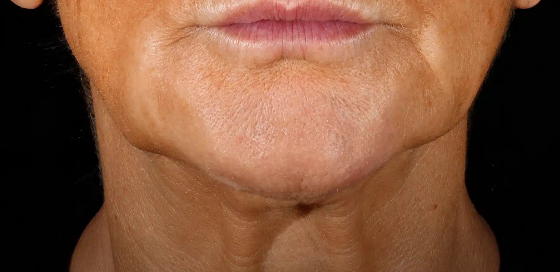 Before XERF treatment showing neck skin laxity and a softened angle between the chin and neck