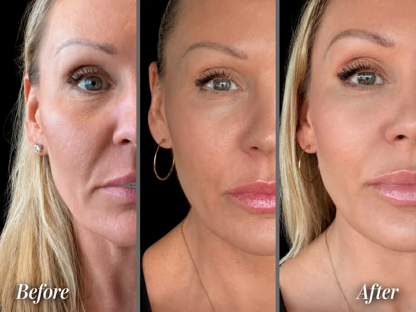 XERF facial skin tightening before and after — Portland OR and Vancouver WA