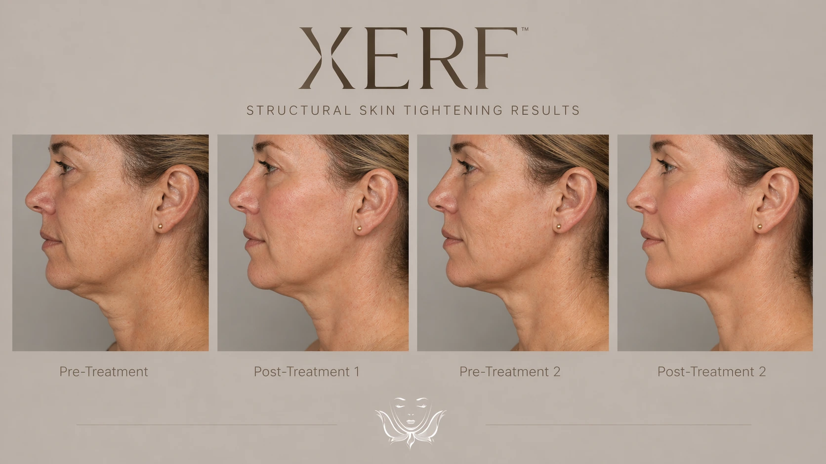 XERF skin tightening before and after two treatments on a woman's lower face and neck, Cosmetiq Medicine